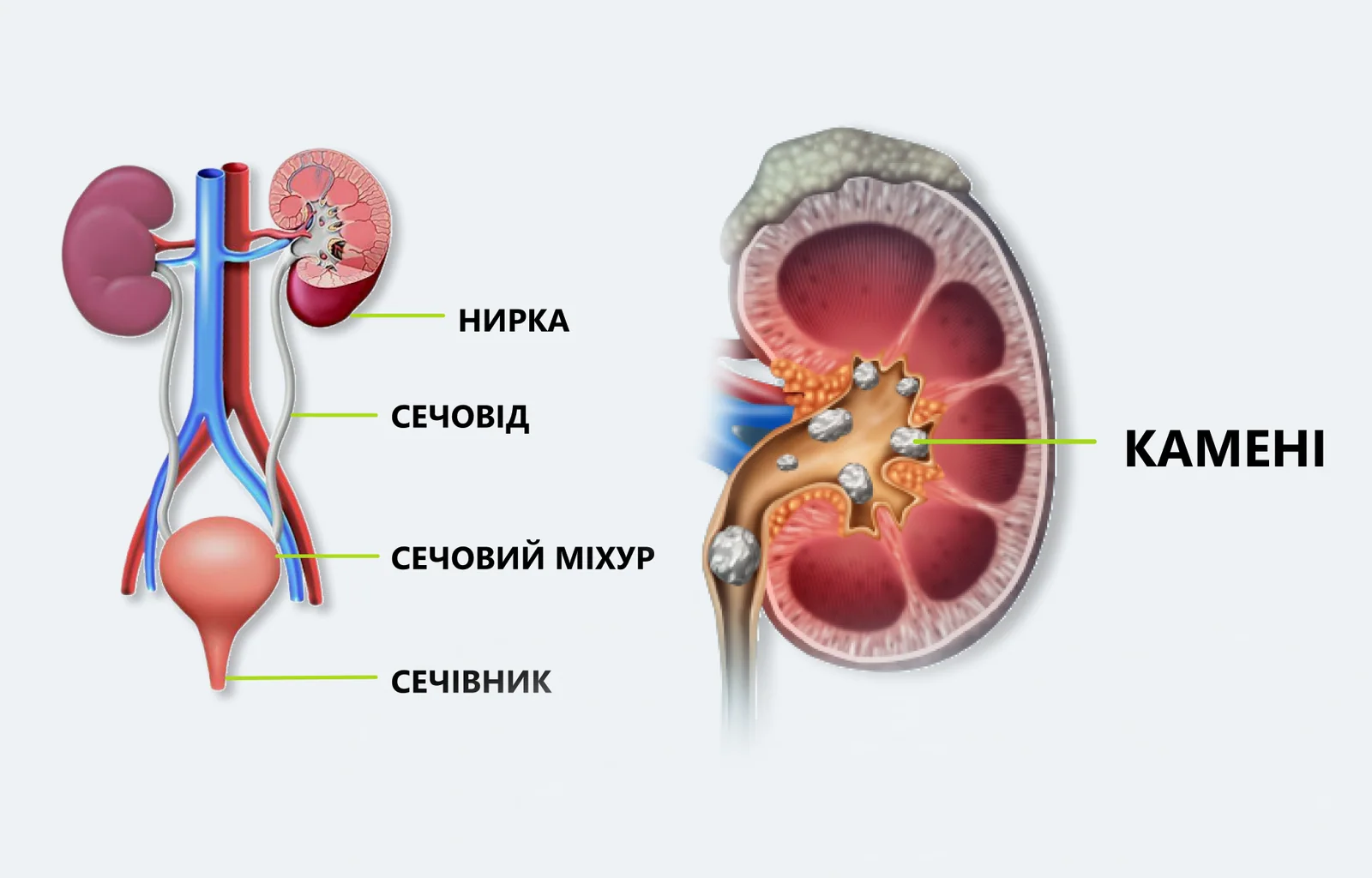 Загальна інформація про сечокам’яну хворобу.