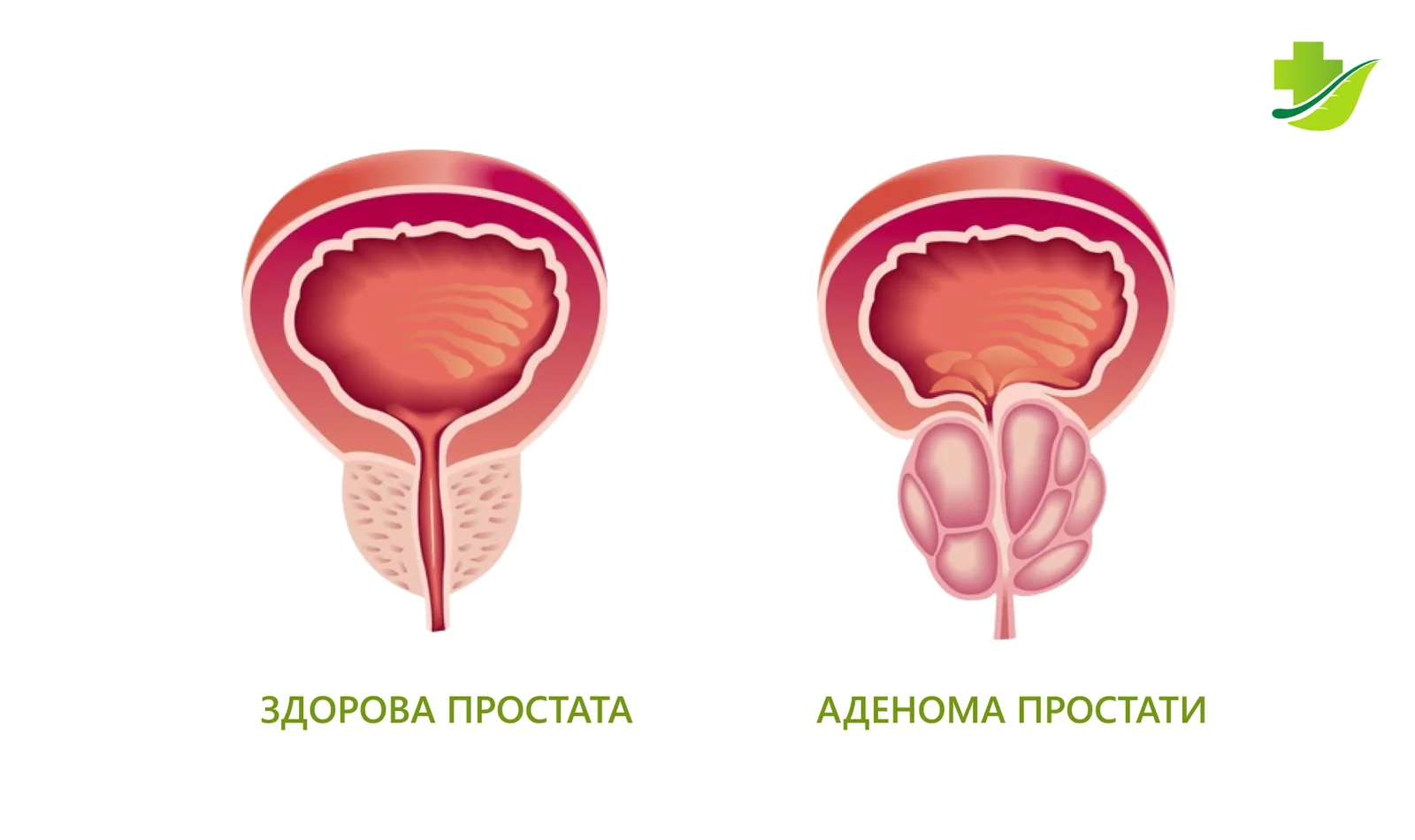 Аденома простати