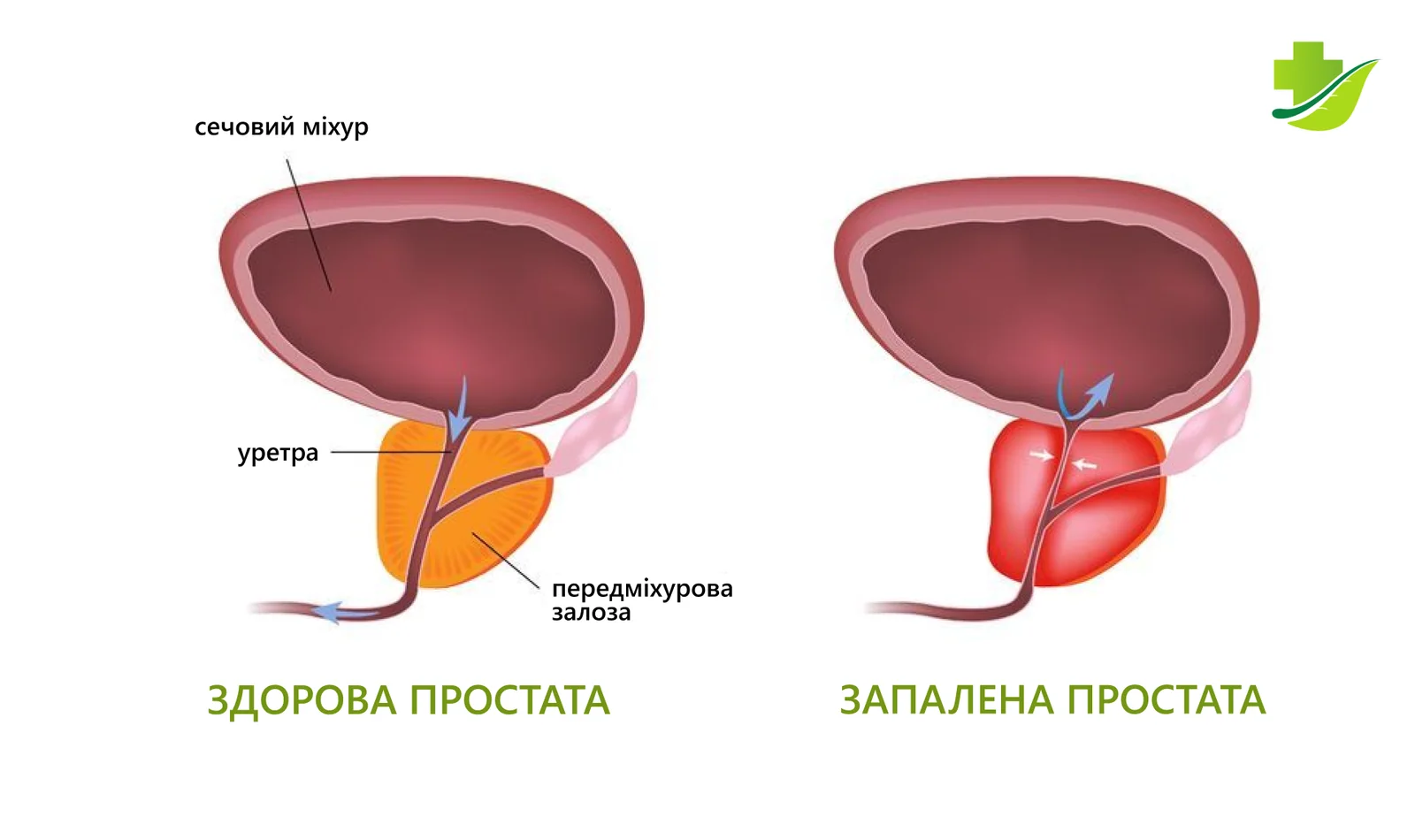 Простатит